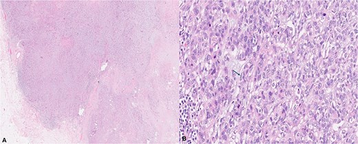 (A) (H&E, 2×) low-power view shows a well-defined neoplastic mass with areas demonstrating both pushing and focally infiltrative borders. (B) (H&E, 20×) high-power view shows neoplastic small, compressed tubules lined by two distinct cell populations with minimal atypia: Inner round luminal epithelial cells and outer polygonal-to-spindled myoepithelial cells with clear cytoplasm (arrow).