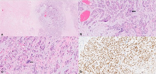 (A) (H&E, 2×) low power view show the neoplasm exhibiting necrosis. (B) & (C) (H&E 10×, 40×) intermediate and high-power views showing neoplastic compressed tubules and trabeculae in a fibro-myxoid matrix background lined by two distinct cell populations with some cells exhibiting marked atypia (arrow). (D) P63 immunohistochemistry (10×) highlights the prominent myoepithelial cells and the atypical cells.