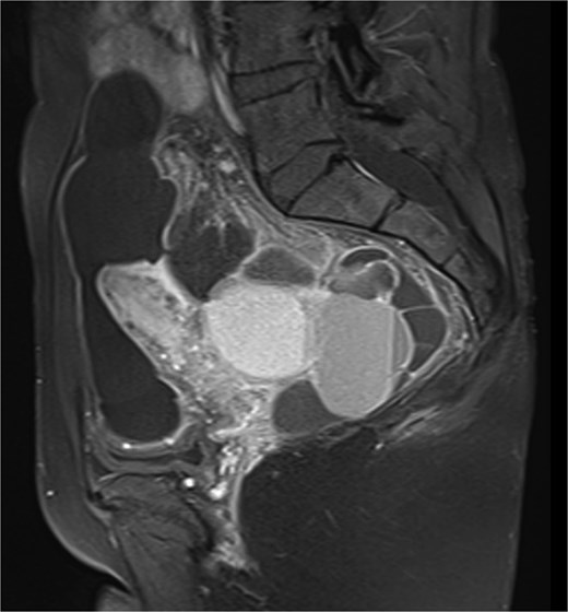 Sagittal T2-weighted pelvic MRI demonstrating a large multilocular cystic lesion occupying the pelvic cavity and displacing adjacent organs.