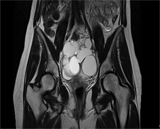 Coronal T2-weighted pelvic MRI showing a large multilocular cystic lesion occupying the pelvic cavity and displacing adjacent organs.