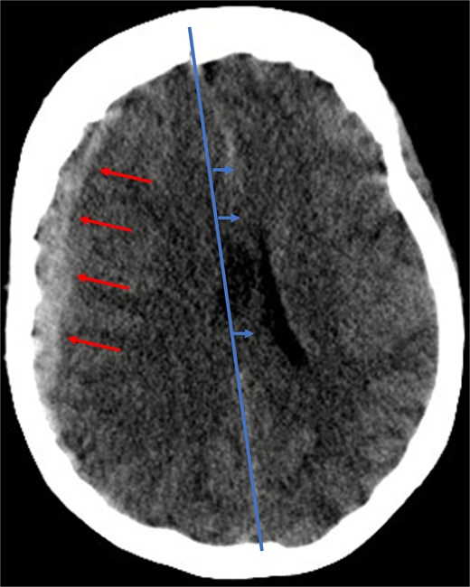 Illustration of a hyperdense, concave 13 mm wide mass as an expression of a subdural hematoma in the right hemispheric region (red arrows) and a consecutive midline shift of 8 mm due to edema (blue arrows).