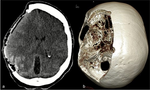 (a) Axial CT image after osteoclastic craniotomy and (b) in the 3D reconstruction representation of the large bone defect.