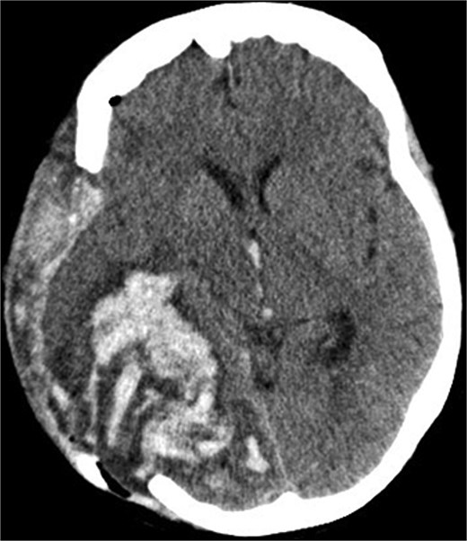 Postoperative axial CT scan. After osteoclastic craniotomy, a large bony defect with parenchymal hemorrhage and additional hemorrhage in the right parietal region is evident.