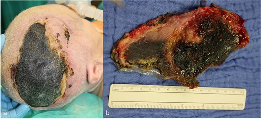 (a) Necrosis of the scalp in the area of the previously performed cranioplasty, (b) explanted necrosis area.