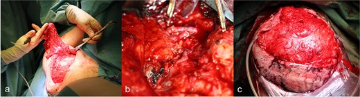 (a) Preparation of the latissimus dorsi muscle flap, (b) anastomosis of the latissimus dorsi muscle flap with the temporal artery and vein, (c) covering of the defect with anastomosed latissimus dorsi muscle flap.