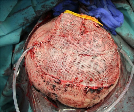 Split skin coverage including two Jackson Pratt drains.