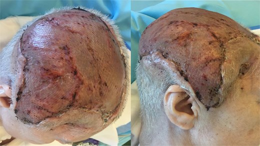 8 weeks postoperative result after latissimus dorsi muscle flap transplantation.