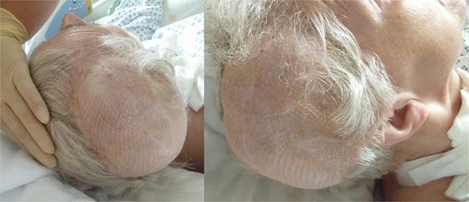 12 months postoperative result after latissimus dorsi muscle flap transplantation.