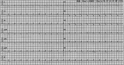 Electrocardiography demonstrated sinus tachycardia and low-voltage complexes.