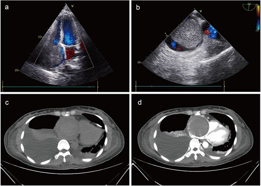 Preoperative imaging. Echocardiography identified a large mass, nearly occupying the entire right atrial cavity (a) and (b). Contrast-enhanced computed tomography showed a right pleural effusion and a right atrial occupying lesion (c) and (d).