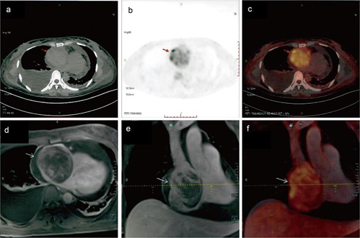 Metabolic imaging. PET-CT (a) and (b) and PET-MR (c) and (d) demonstrated a hypermetabolic soft tissue mass within the right atrium, highly suggestive of primary cardiac angiosarcoma.