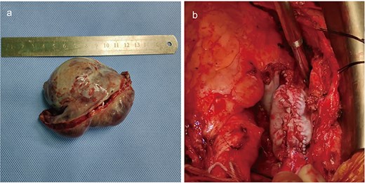Intraoperative imaging. The mass was completely resected (a). The involved portions of the right atrial wall and venae cavae, was performed, followed by reconstruction using bovine pericardium (b).