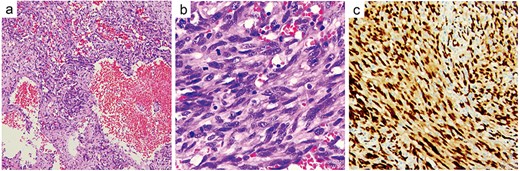 Histopathological examination. The resected specimen exhibiting marked cellular atypia, frequent mitotic activity, and prominent vasoformative features (a) and (b). Immunohistochemical staining was positive for ERG (c).