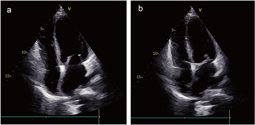Postoperative images. The echocardiogram indicated no signs of local recurrence (a) and (b).