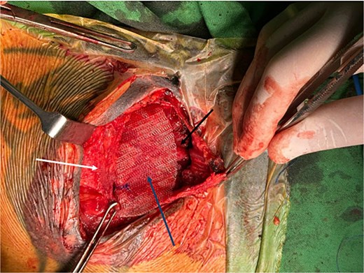 Intraoperative image showing polypropylene mesh (blue arrow) positioned between the PM muscle (black arrow) and the overlying pectoral fascia (white arrow). The sternum is to the right of the image.