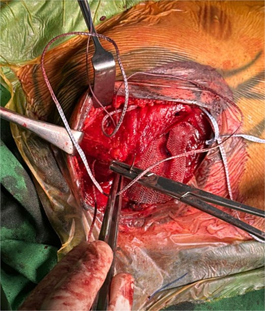 Intraoperative image showing suturing of the PM muscle and mesh to the overlying pectoral fascia.