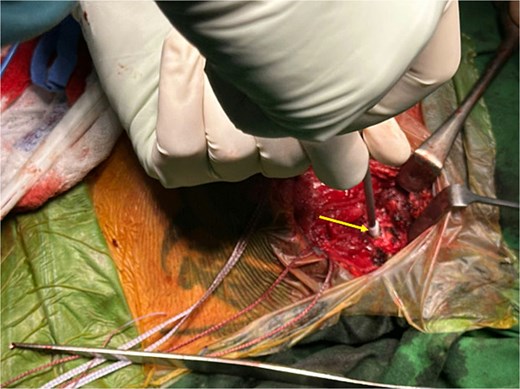 Intraoperative image showing insertion of a knotless suture anchor (arrow) into the sternum.