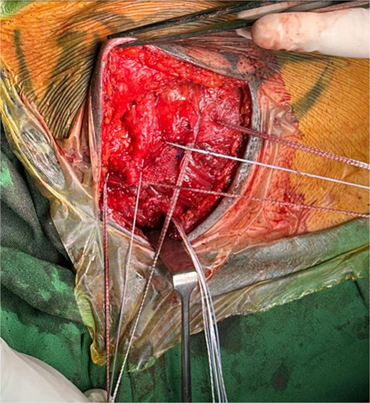 Intraoperative image showing placement of sutures through the mesh and PM muscle prior to securing them with sternal anchors.