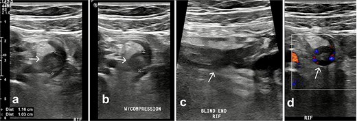Ultrasound of the right iliac fossa. Transversal ultrasound image of the appendix (white arrow). (a) Before compression. (b) During compression, showing an uncompressible distended appendix (cursors). (c) At the level of the right iliac fossa, there is a blind-ending tubular structure.