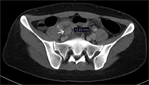 CT axial plane demonstrated a thickened appendix (white arrow) in the right iliac fossa measuring 12 mm.