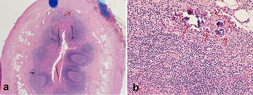 Histopathological section stained with H&E for the excised appendix: (a) (magnification 4×) an appendix shows acute appendicitis with transmural acute inflammation, a calcified Schistosoma egg is indicated by an arrow. (b) (magnification 40×) multiple calcified Schistosoma eggs in the submucosal layer of the appendix (arrows).