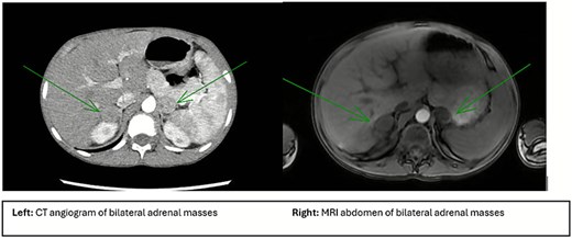 Imaging characteristics of adrenal pathology. Left image shows a CT abdomen and pelvis with arrows pointing to the bilateral adrenal masses measuring 2.5 × 2.0 cm on the right and 2.3 × 2.3 cm on the left. Right image shows an MRI of the abdomen and with arrows pointing to bilateral adrenal masses. Right mass is measured at 2.4 × 2.4 × 2.3 cm and is solid, homogeneous with a more dense capsule and moderate restricted diffusion. The left mass is measured at 2.0 × 2.3 × 2.0 cm and has a more heterogeneous appearance with small cystic components, cortex of the lesion with restricted diffusion.