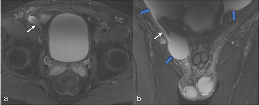 In the MRI examination of the pelvic region, the fat-suppressed, fluid-emphasized imaging in the axial section (a) shows a hernial orifice of ~1 cm (white arrow) and in the cronar section (b) the hernial orifice (white arrow) with ascites in the lesser pelvis and in the hernial sac/funiculus spermaticus (blue arrows).