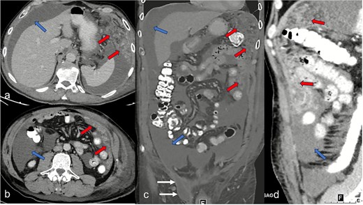 Abdominal CT imaging shows clear ascites (blue arrows) in all quadrants in the axial segments (a and b), the coronary segment (c), and sagittal segment (d), and a tumor-specific structure with thickening of the peritoneum and the greater omentum (red arrows). In (c) representation of the hernial orifice (white arrows).