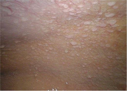 Diagnostic laparoscopy. The image shows the nodularly altered peritoneum.