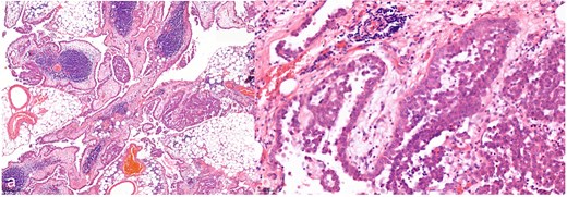 Hematoxylin and eosin staining with a 7.2-fold (a, overview image) and 40-fold (b, detail image) magnification. The histological images show a malignant epithelioid mesothelioma of the peritoneum; atypical tumor cell clusters located in papillary and exophytic formations can be seen.