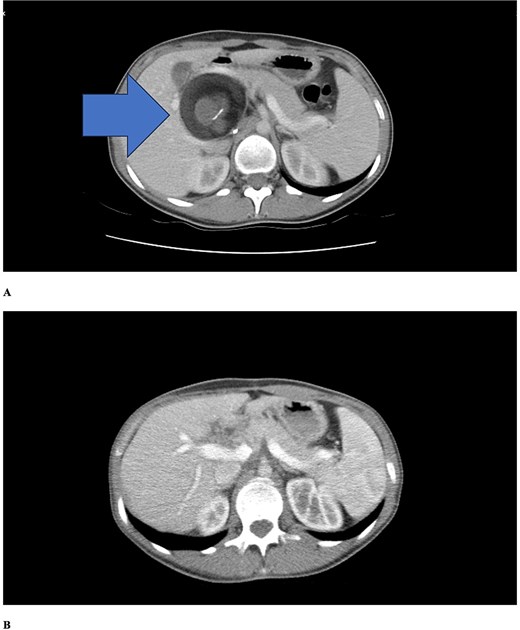 Contrast-enhanced axial CT scans. (a) Preoperative imaging showing a well-defined cystic lesion in the hepatoduodenal ligament region with heterogeneous attenuation including areas of fat density (negative Hounsfield units) and fluid components. (b) Six-month postoperative follow-up demonstrating complete resolution of the lesion with no evidence of recurrence. Periportal millimetric metallic densities representing surgical clips are visible.