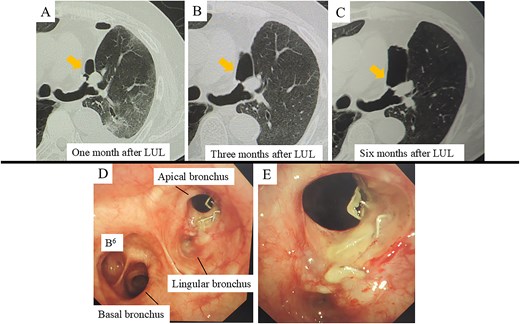 CT and bronchoscopic findings post-left upper lobectomy (LUL). (A–C) CT scans obtained at 1, 3, and 6 months postoperatively. Panel A shows a small airspace (gold arrow) near the upper segment of the bronchial stump that progressively enlarges over time. (D–E) Bronchoscopic images at 6 months demonstrate failure of the staple line for the upper division bronchus (B1 + 2, B3) at the upper lobe bronchial stump, resulting in an ~10 mm complete separation with surrounding whitish changes.