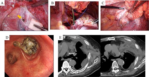 Intraoperative and early postoperative findings. (A–C) Panel A identifies the fistula at the upper lobe bronchial stump (arrow), adjacent to the pulmonary artery. Panel B shows a bronchoscope being used to guide the biopsy forceps from the fistula site into the thoracic cavity to grasp the latissimus dorsi muscle flap. Panel C shows the flap secured into the bronchial lumen in a retrograde fashion, with fibrin glue applied for reinforcement. (D) Bronchoscopic view on postoperative day 7 confirms visibility of the latissimus dorsi muscle flap within the bronchial lumen. (E) CT scans on postoperative day 7 demonstrate secure suturing of the latissimus dorsi muscle flap to the fistula site and resolution of the preoperative airspace.
