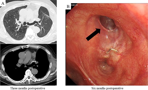 Postoperative CT imaging and bronchoscopic evaluation. (A) CT scans at 3 months postoperatively reveal no recurrence of air leakage, indicating a stable clinical course. (B) Bronchoscopic examination at 6 months postoperatively shows satisfactory granulation tissue formation at the upper lobe bronchial stump, consistent with complete healing.