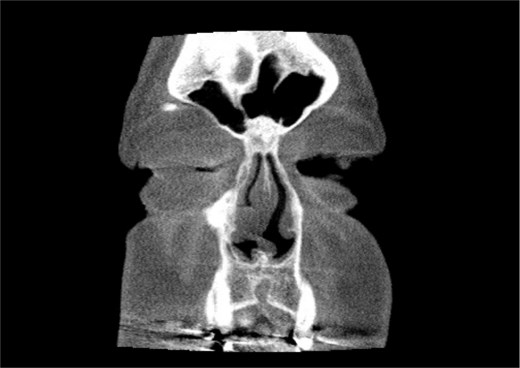 Coronal non-contrast CT scan images of soft tissue lesion on right inferior turbinate.