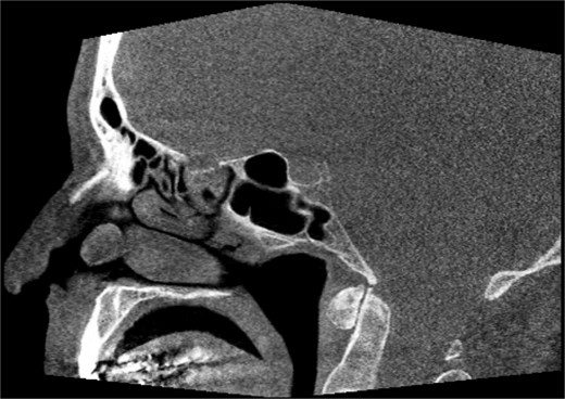 Sagittal non-contrast CT scan images of soft tissue lesion on right inferior turbinate.