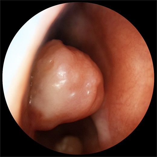 Nasal endoscopy depicting lesion in caudal right nasal cavity.