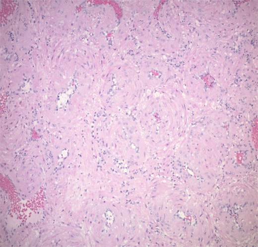 The tumour is composed of bland myoid spindle cells growing in a concentric pattern around numerous small vessels.