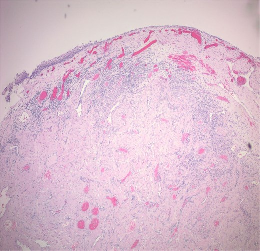 Tumour is unencapsulated, involving mucosa.