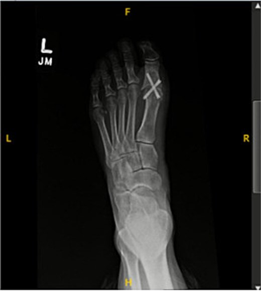 Postoperative radiograph showing first metatarsophalangeal joint arthrodesis with two headless compression screws.
