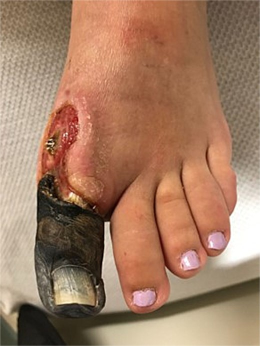 Clinical photograph showing dry gangrene of the hallux.