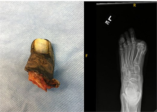 Gross specimen of amputated hallux (left) and postoperative radiograph following metatarsophalangeal joint amputation and screw removal.