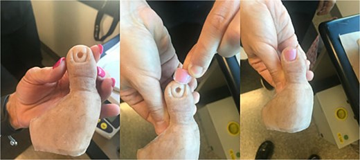 Custom prosthetic device for the great toe.