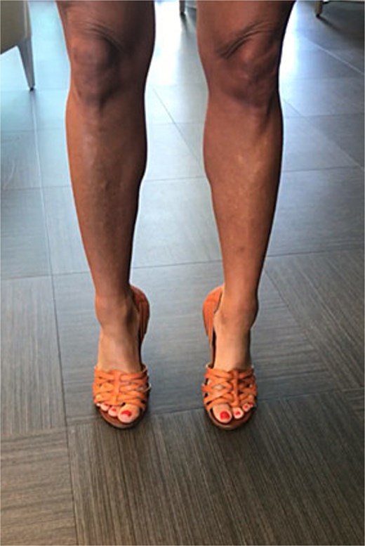 Patient wearing custom great toe prosthesis with restored cosmesis and function.