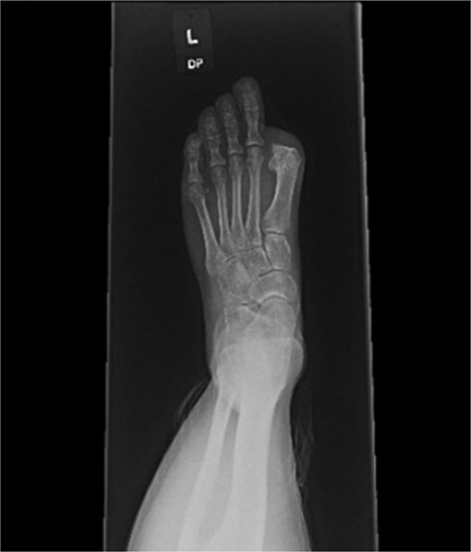 Radiographs at one year demonstrating satisfactory healing.