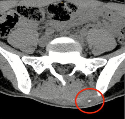 CT lumbosacral spine showed a left paraspinal calcified haematoma.