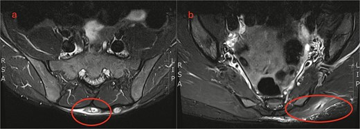 MRI lumbosacral spine. (a) Axial view shows a soft tissue mass overlying the sacrum. (b) Sagittal view shows a linear extension tracking down to the left gluteus maximus.