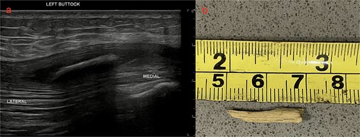 US left buttock and photo of wooden splinter (a) US left buttock shows a 20 × 2 mm hyperdense foreign body within the left gluteus maximus 12 mm deep. (b) Photo of wooden splinter after retrieval.