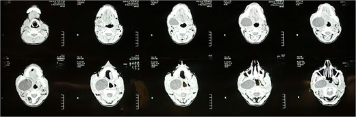 Axial cuts of CT scan showing a well-defined cystic lesion occupying the right parapharyngeal space.