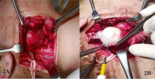 Excision of right parapharyngeal space via transcervical approach with dissection plane reaching to the cystic swelling (A), and then the superficial tissue being dissected meticulously to reveal the optic white walls of the hydatid cyst (B).